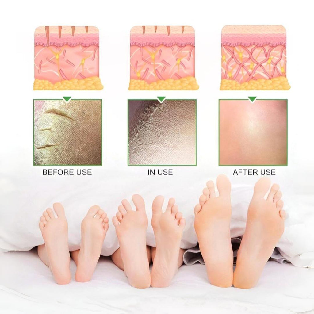South Moon - 42% Urea Cream + 2% Salicylic Acid (Original)